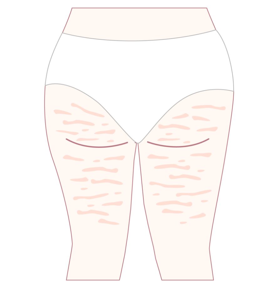 After Cellulite Removal