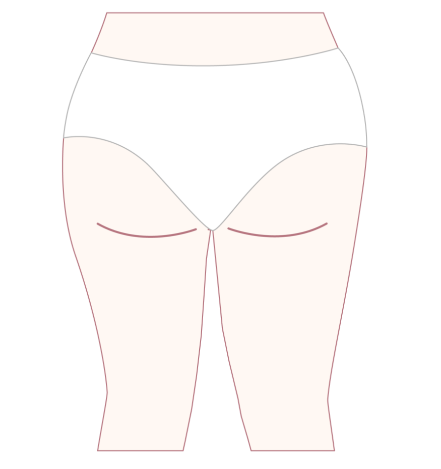 Before Cellulite Removal