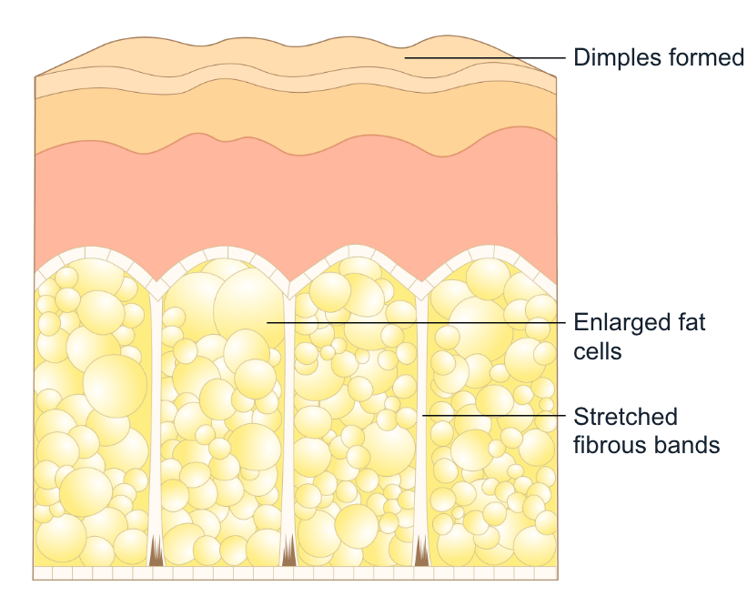 Cross-Section of Cellulite