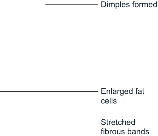 Cross-Section of Cellulite