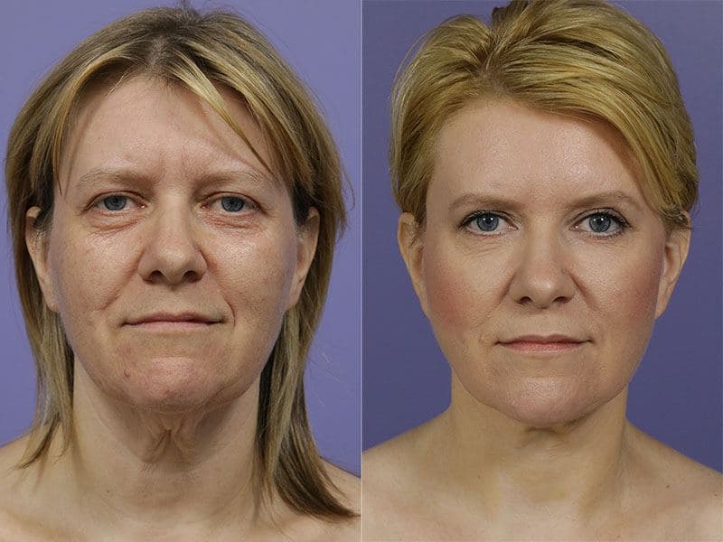 before and after facelift procedure
