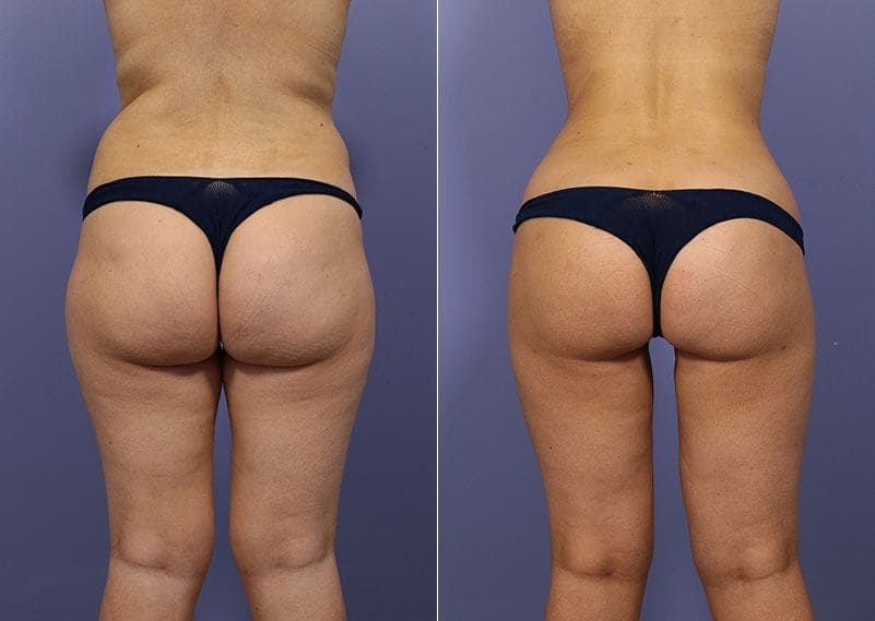 before and after posterior lift procedure