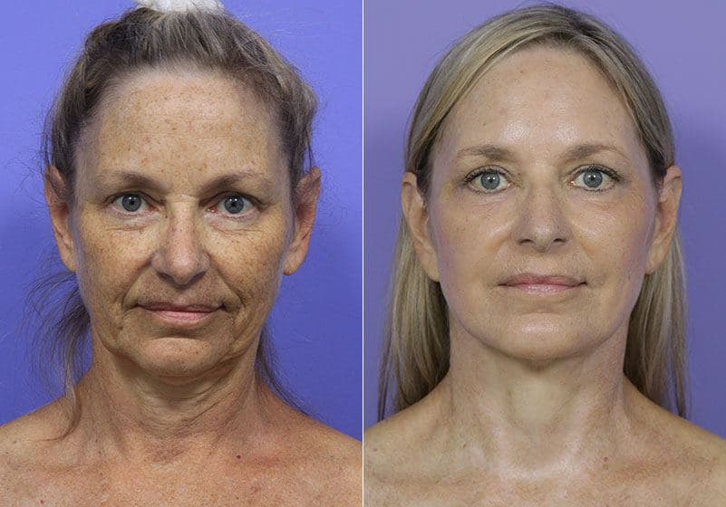 before and after facelift procedure