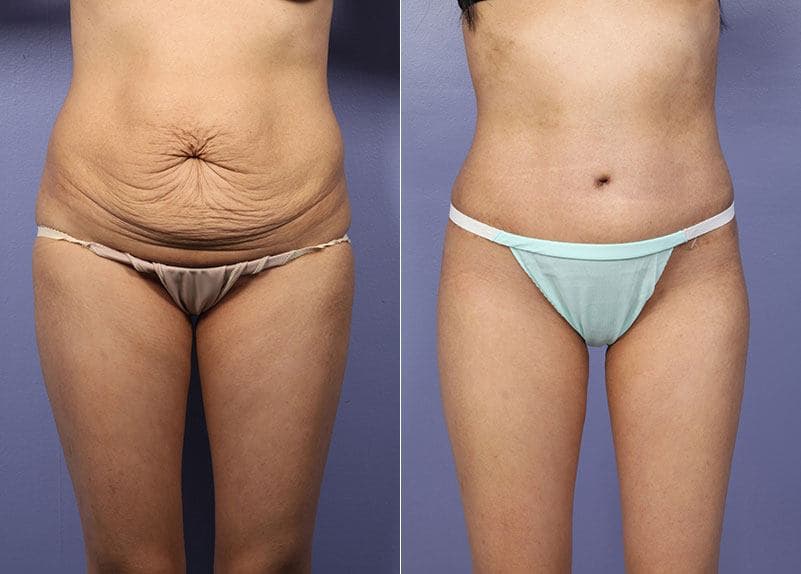 before and after tummy tuck procedure
