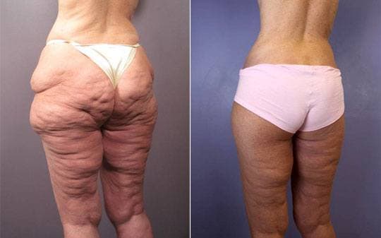 before and after tummy tuck procedure