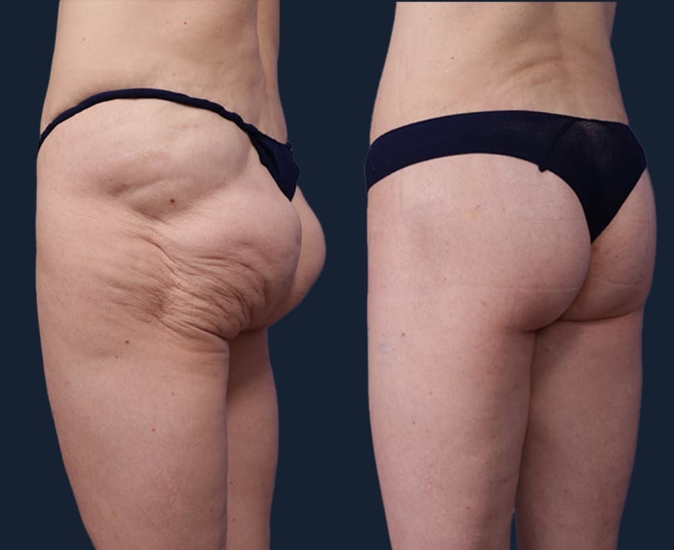 Before and After Body Lift Procedure