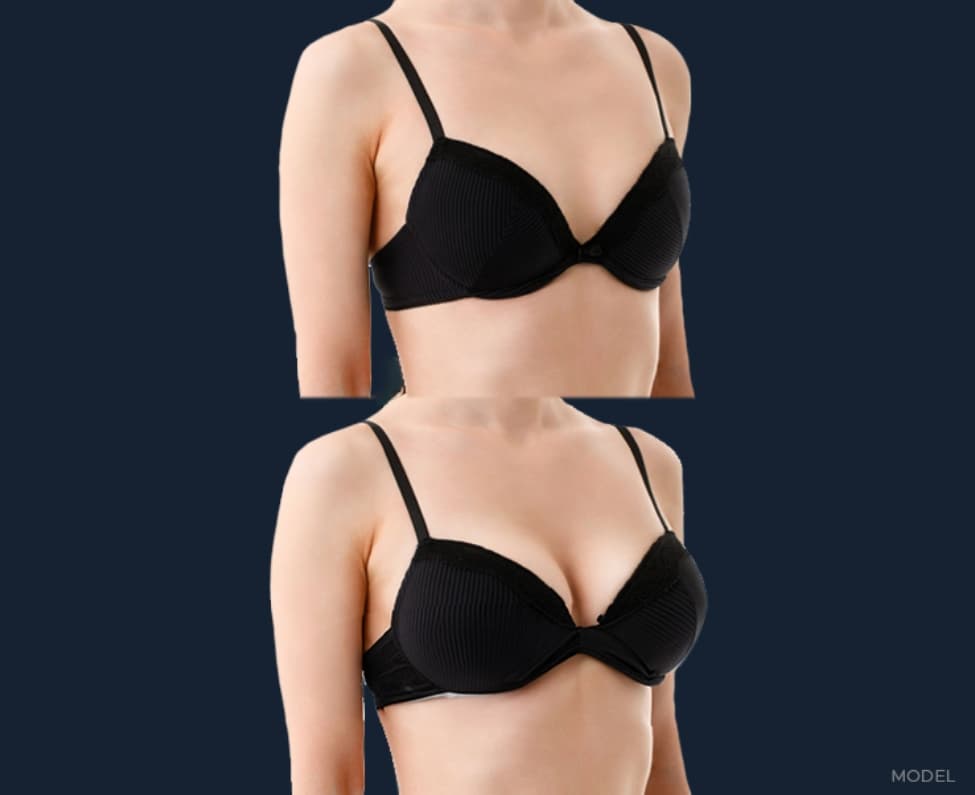 Before and After of a Breast Augmentation