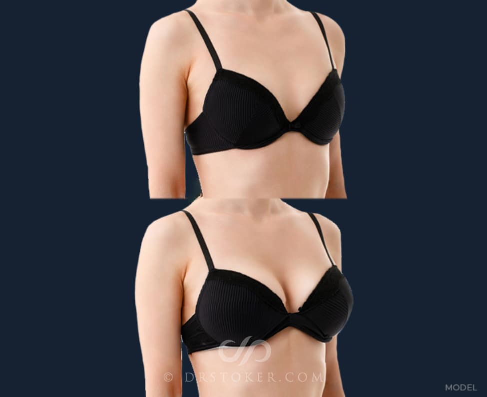 Before and After of a Breast Augmentation