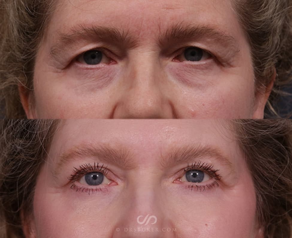 Before and After Eyelid Surgery Procedure