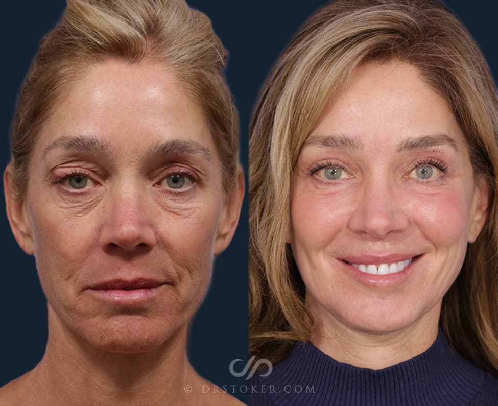 Before and After Facelift Procedure