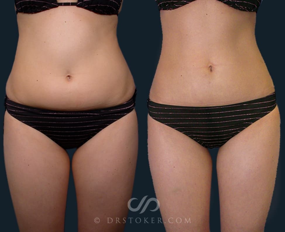 Before and After Liposuction Procedure