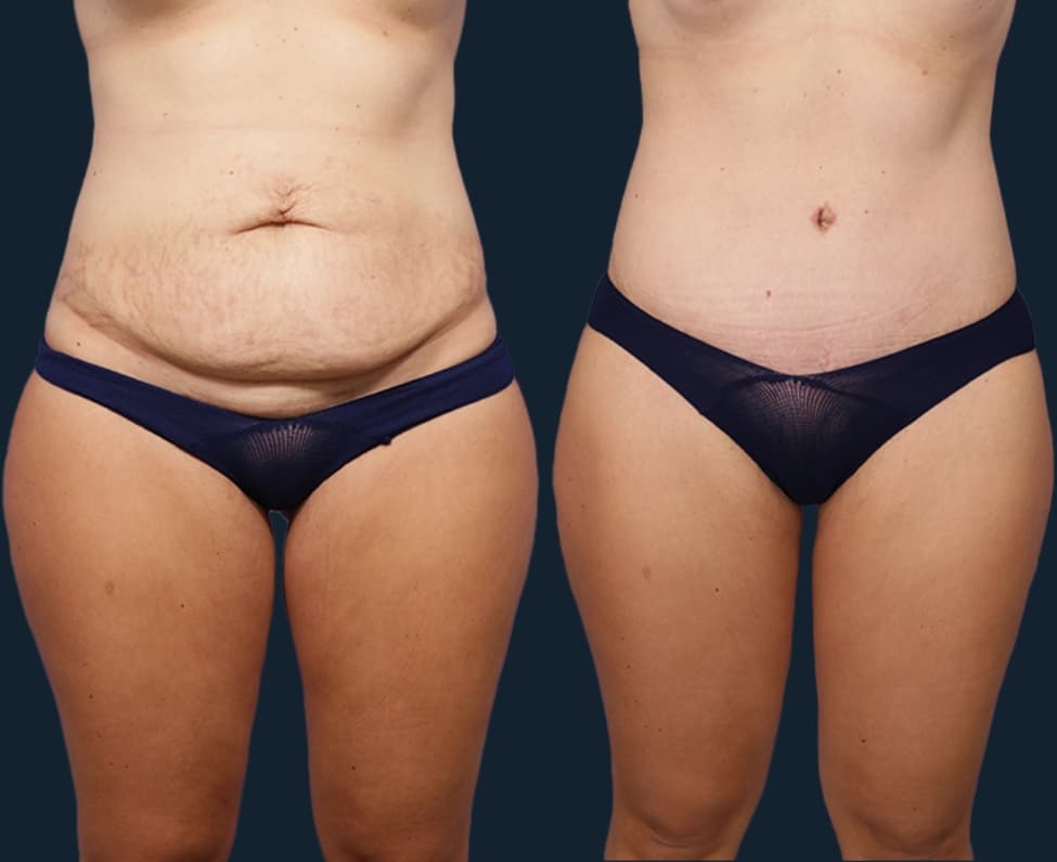 Before and After of Tummy Tuck Procedure