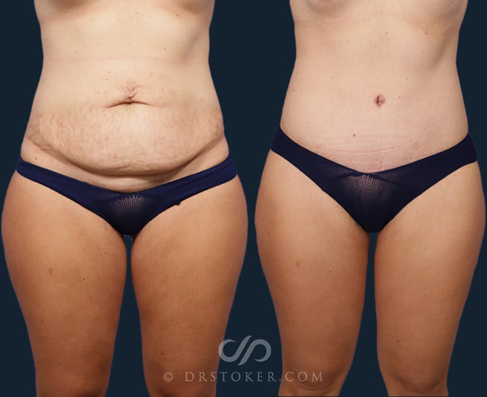 Before and After of Tummy Tuck Procedure