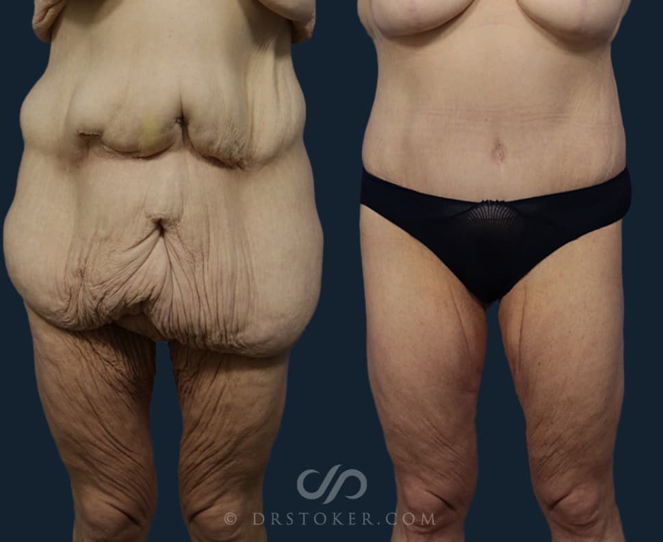 Before and After Weight Loss Surgery Procedure