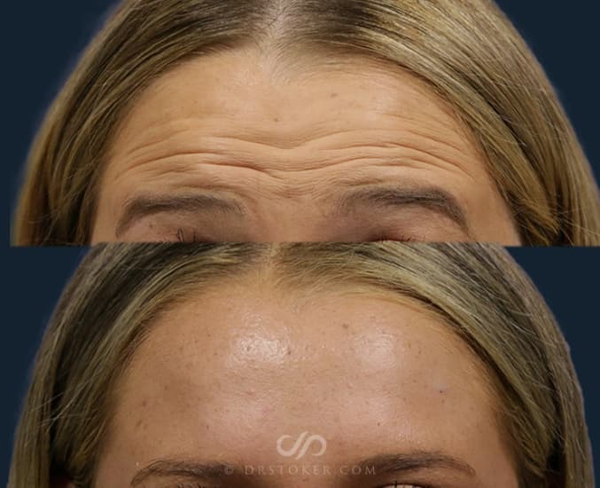 Before and After Botox Procedure