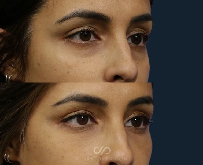 Before and After Dermal Filler Procedure