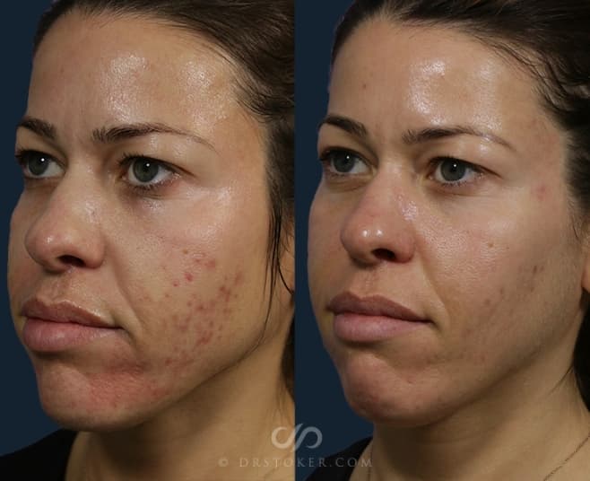 Before and After Microneedling Procedure