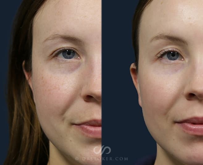 Before and After Chemical Peels Procedure