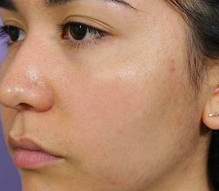 After acne treatment