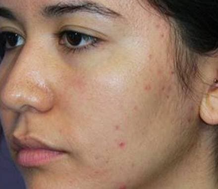 Before acne treatment