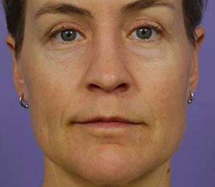 After aging skin treatment