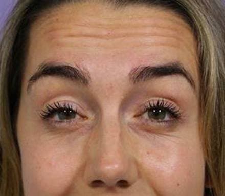 Before forehead wrinkles treatment