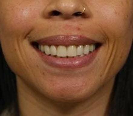 After gummy smile treatment