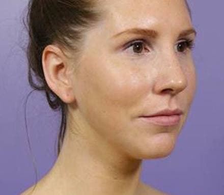 After hyperpigmentation/melasma treatment