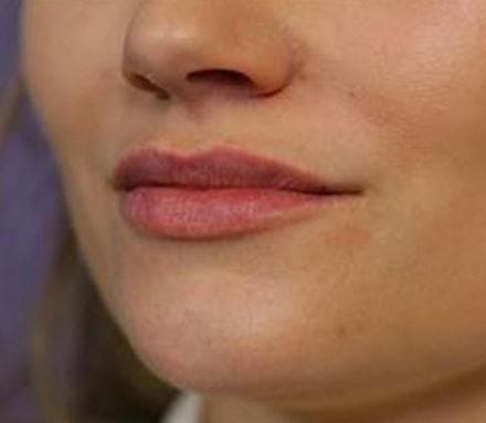 After lip shape/size treatment