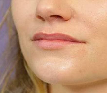Before lip shape/size treatment