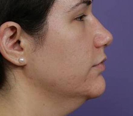 After mandible angle/jawline contouring treatment