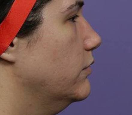 Before mandible angle/jawline contouring treatment