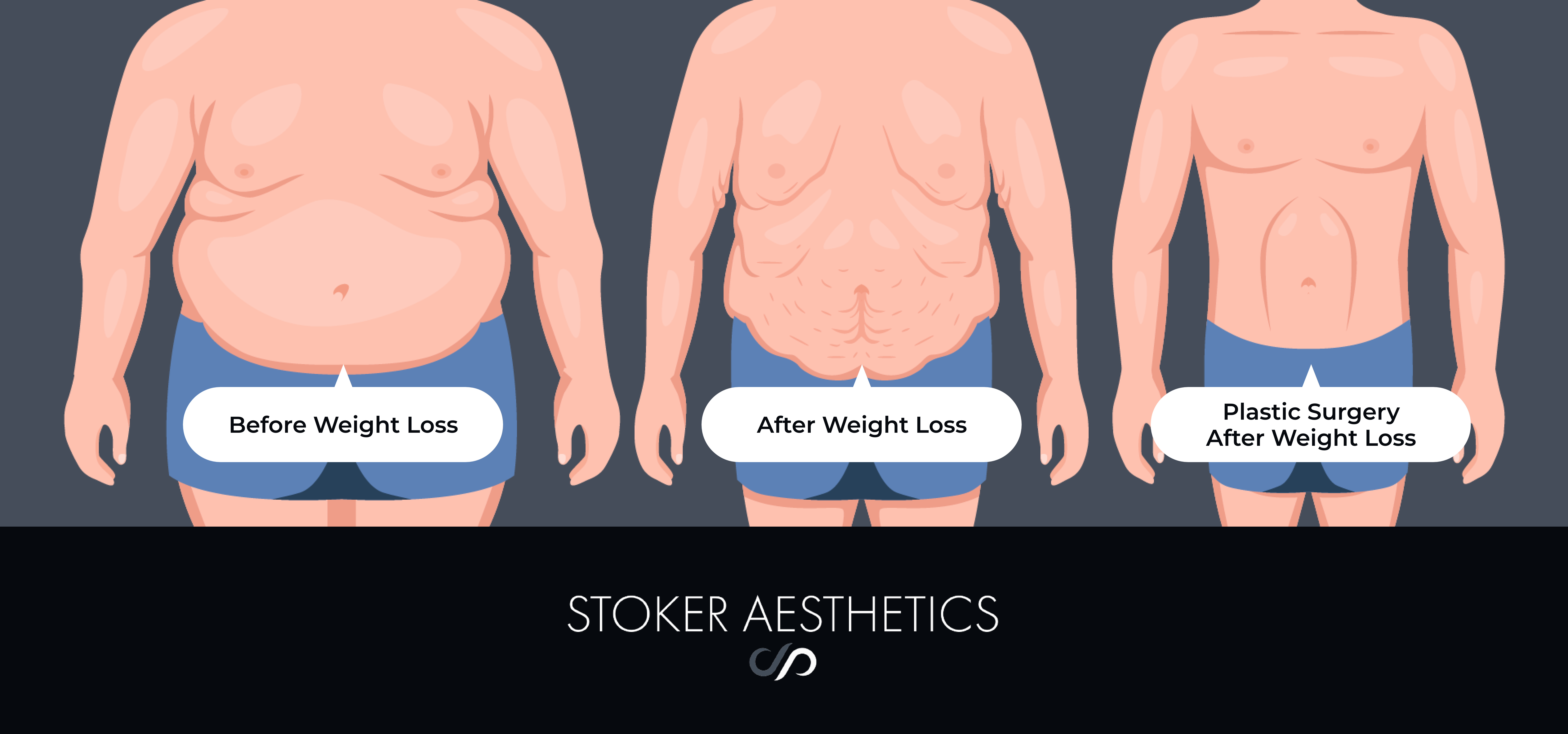 Plastic Surgery After Weight Loss