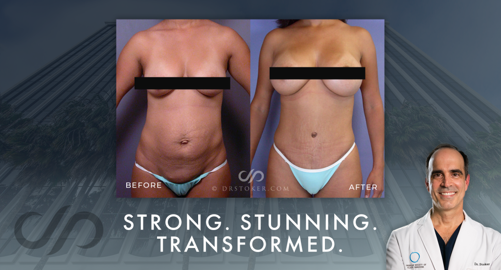 Strong. Stunning. Transformed. Before and after breast augmentation image.