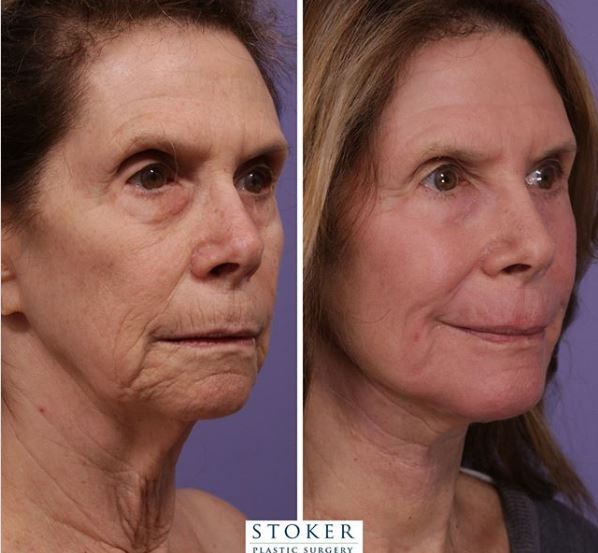 Before and after total facial rejuvenation on a 72-year-old woman. 