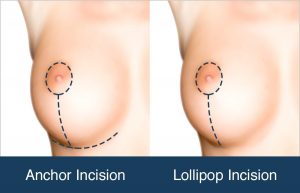 Illustration showing breast lift anchor incision and lollipop incision