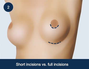 Breast Lift Diagram - #2 Short vs. Full Incisions
