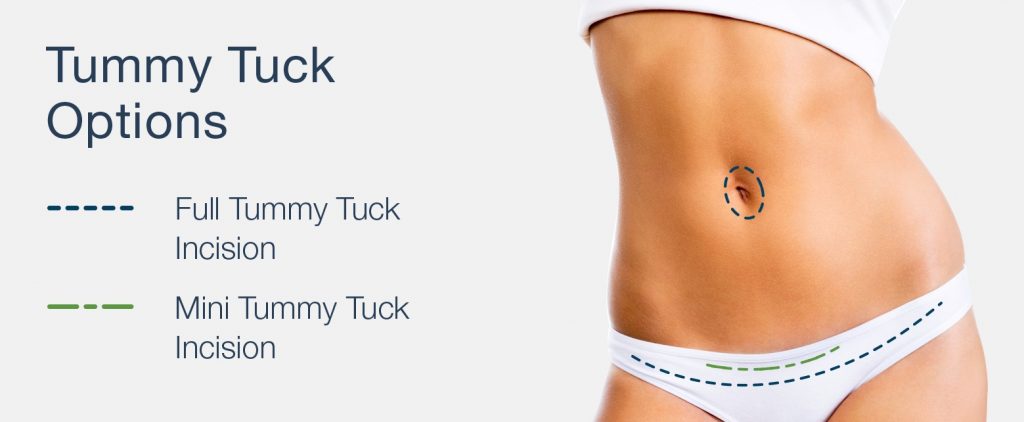 tummy tuck incision options