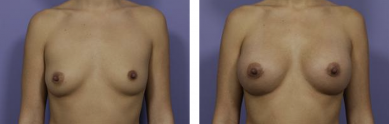 breast augmentation before and after photos