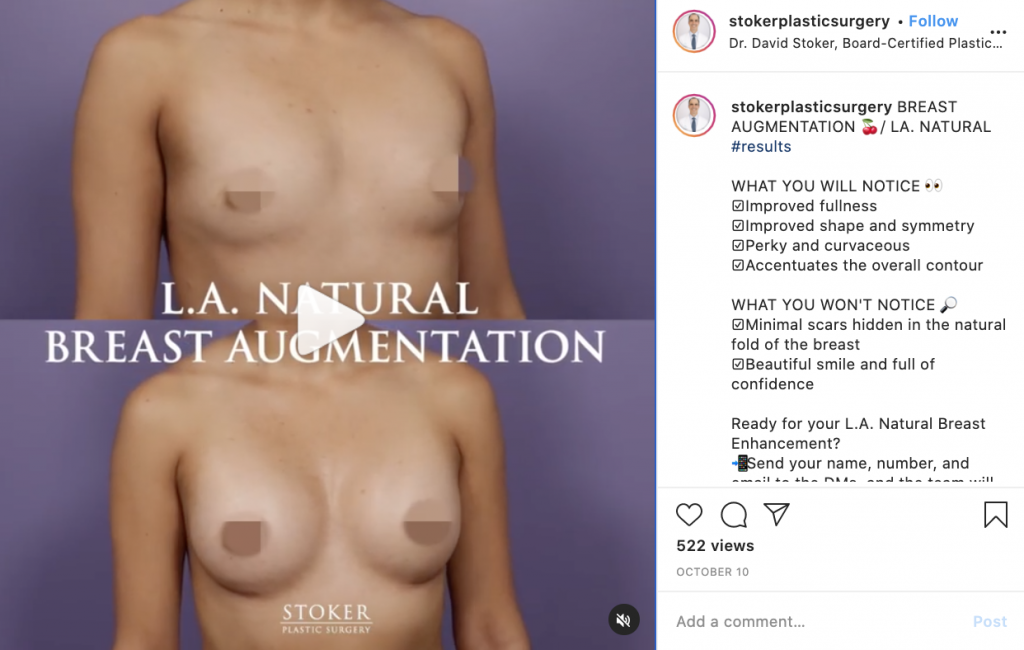 breast augmentation before and after photos