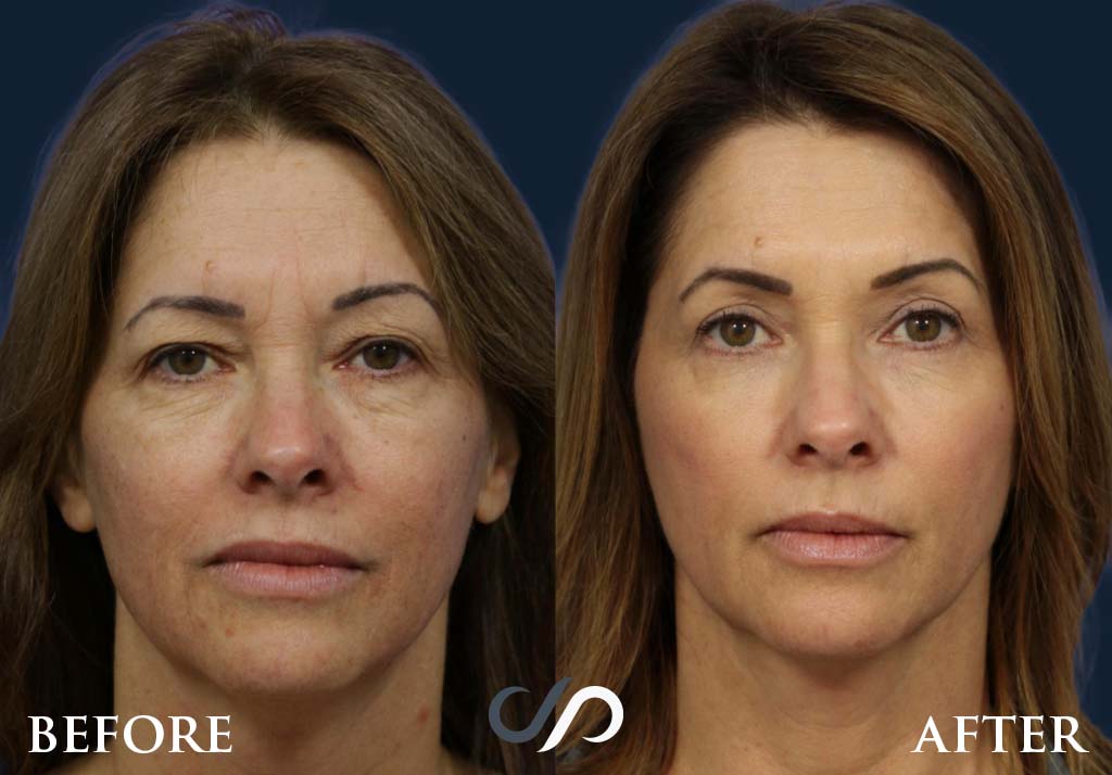 laser skin resurfacing before and after photos