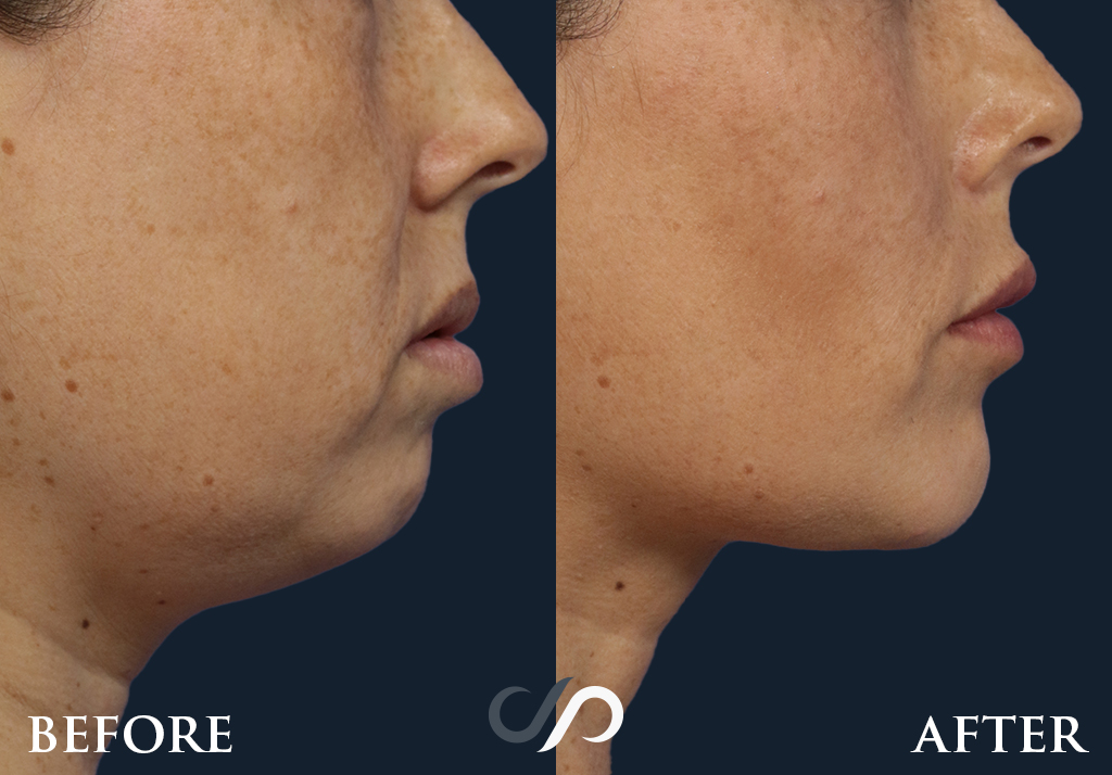 Chin augmentation before and after photos