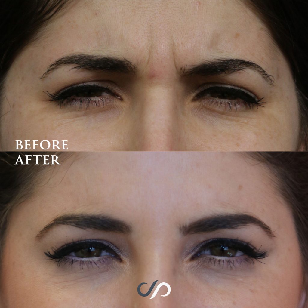 before and after BOTOX Cosmetic in Los Angeles, CA