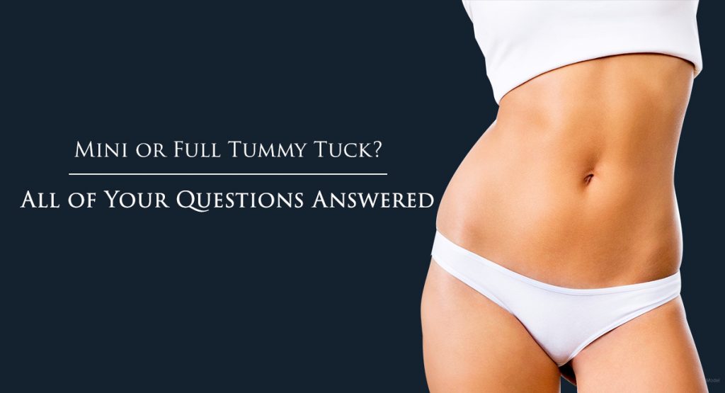 Mini or Full Tummy Tuck? All of your questions answered.