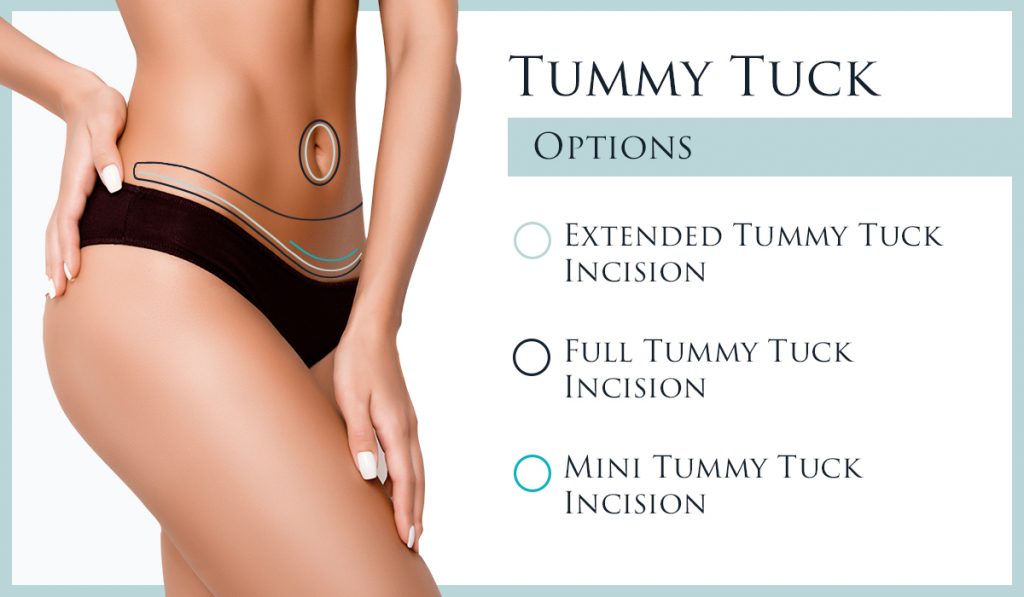 Image of tummy tuck incision areas for three different types of tummy tucks.