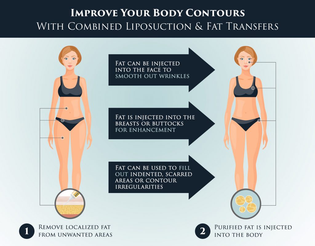 Fat transfer can add volume and improve your body contours. 