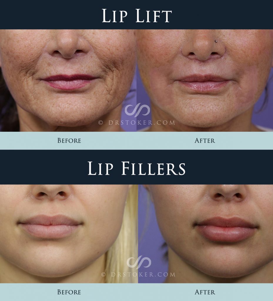 Lip Lift vs Filler Before and After