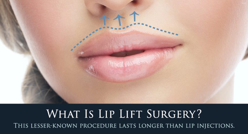 Lip lift in Los Angeles CA