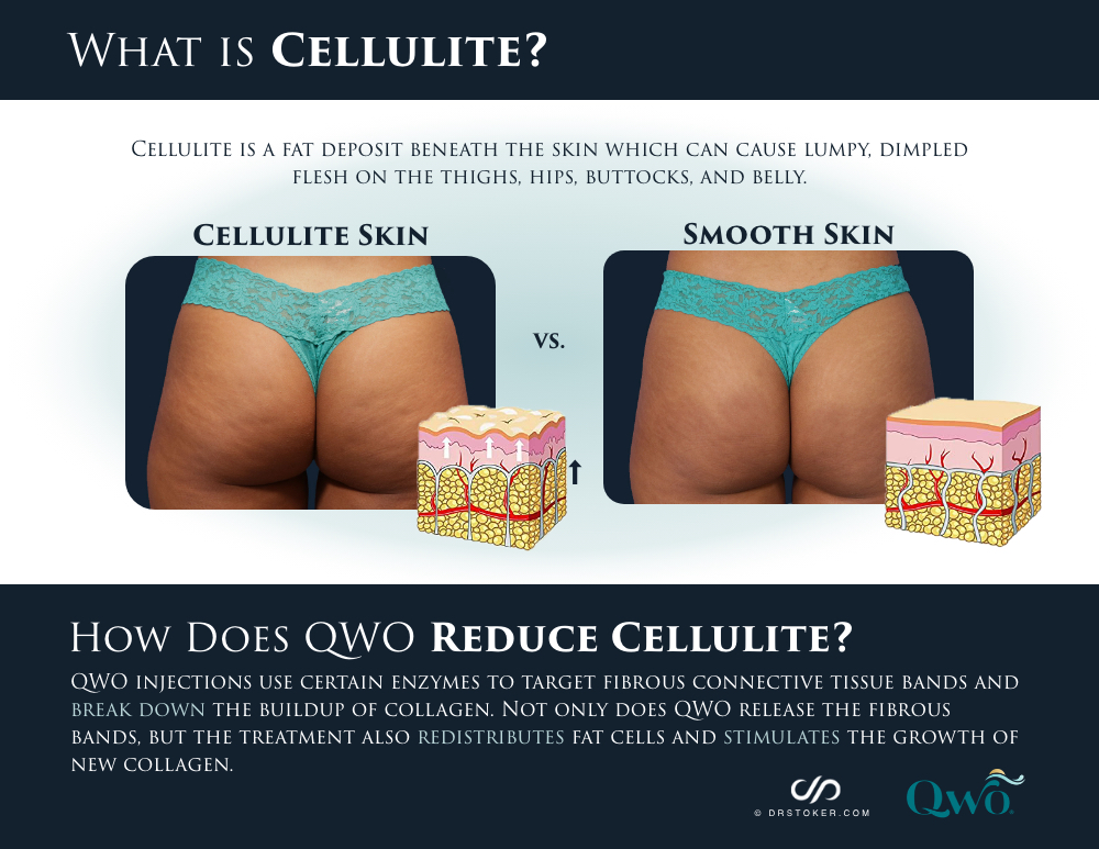 What is cellulite?