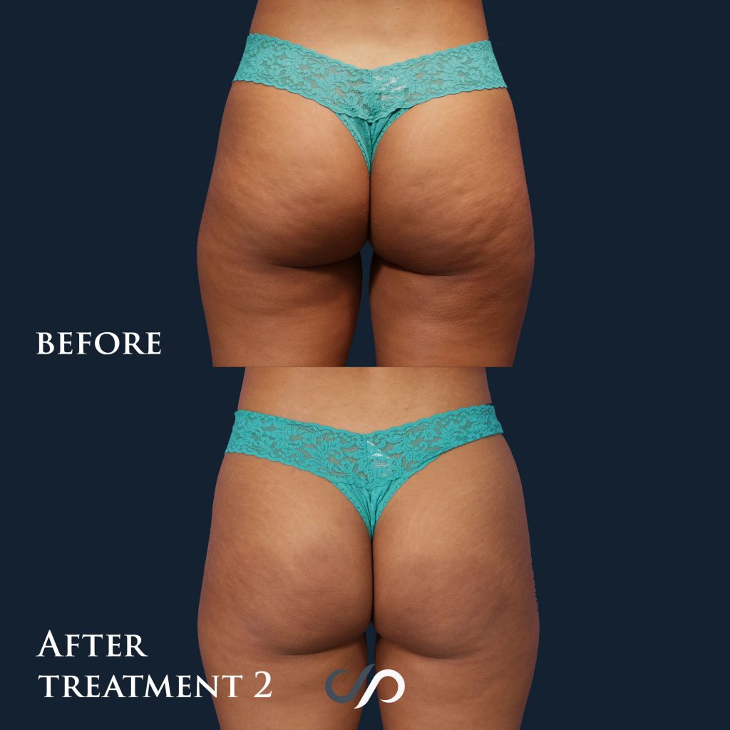 QWO cellulite treatment before and after photos of buttocks